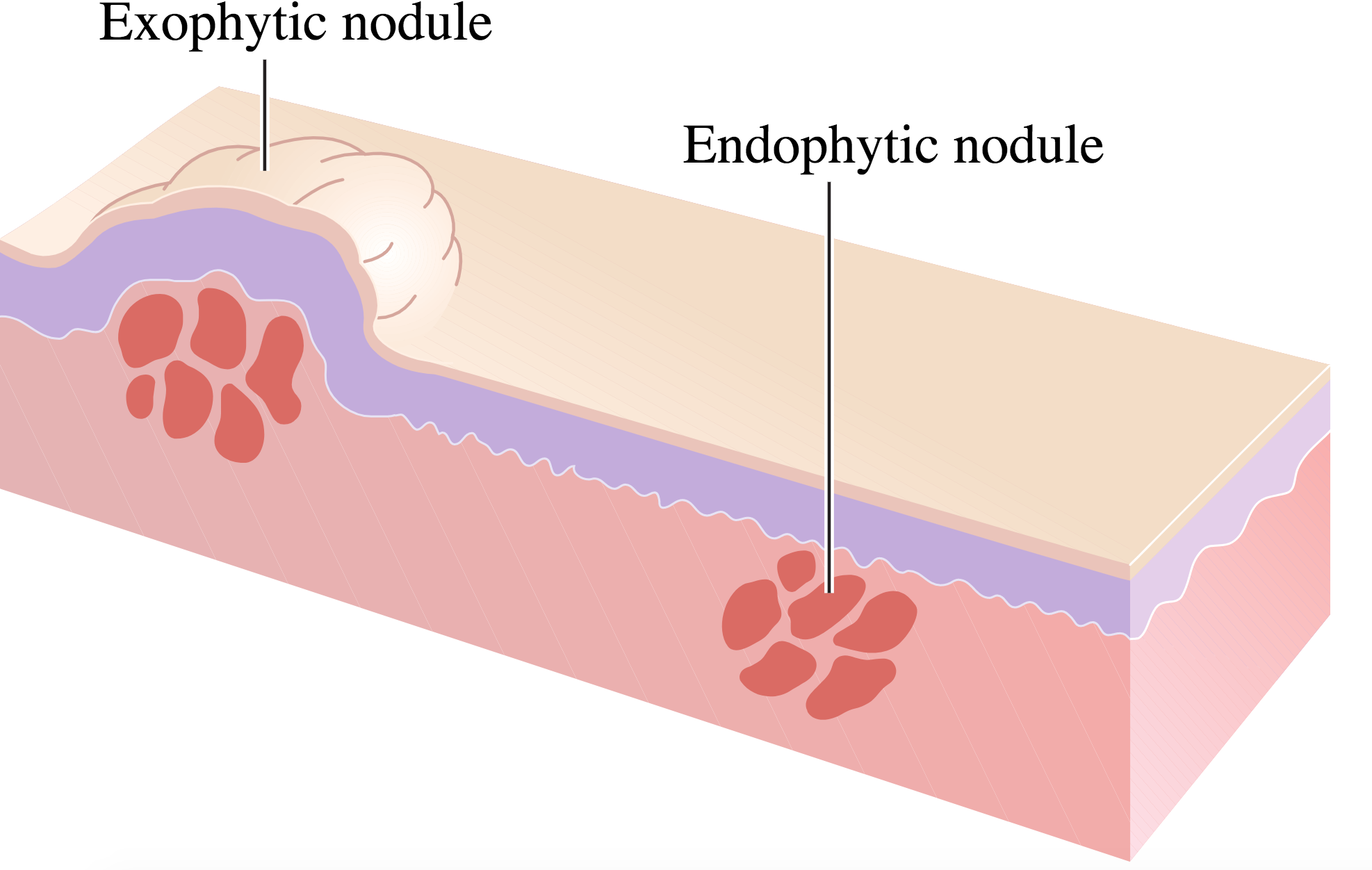 Que sont les nodules thyroïdiens ?
